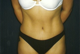 Abdominoplasty Images 11375