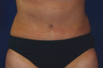 Forest Hills Tummy Tuck