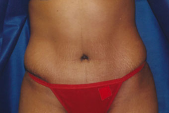 Forest Hills Tummy Tuck