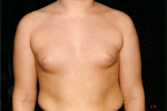 Liposuction in Forest Hills